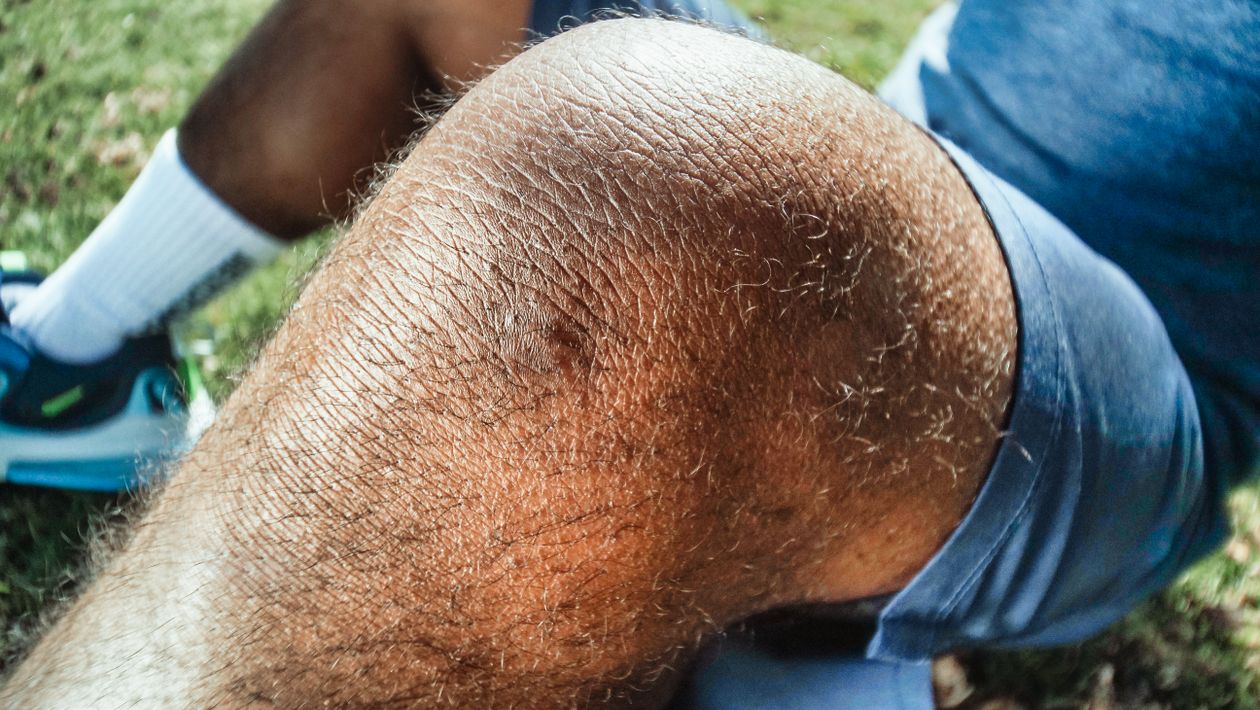 close-up of an injured knee with bruising captured outdoors showing knee joint damage in active adults